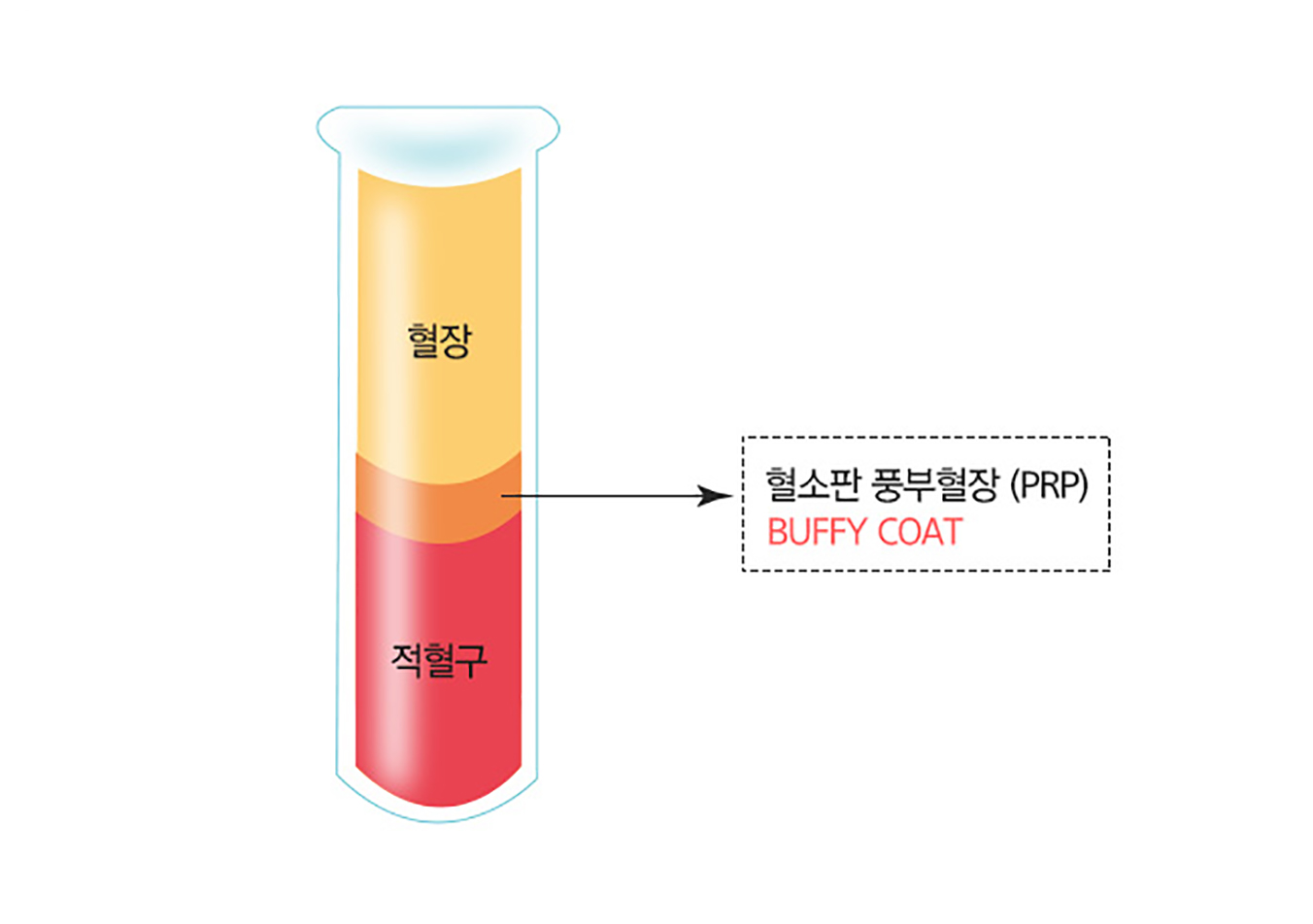 PRP 지방이식